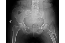 Kalça Kemiği Çatlağı Belirtileri ve Tedavisi