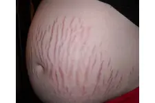 Gebelikte Çatlak Belirtileri ve Tedavisi