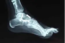 Parmak Çatlağı Belirtileri ve Tedavisi