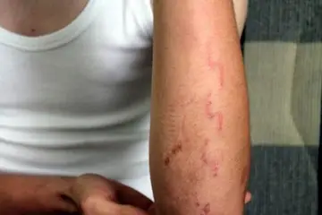 Kolda Çatlak Belirtileri ve Tedavisi