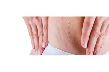 Vücut Çatlakları Belirtileri ve Tedavisi