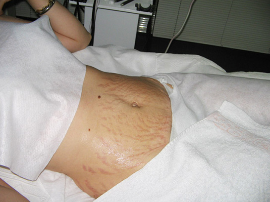 Çatlak Estetiği Belirtileri ve Tedavisi